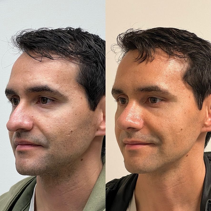 Rhinoplasty Before & After