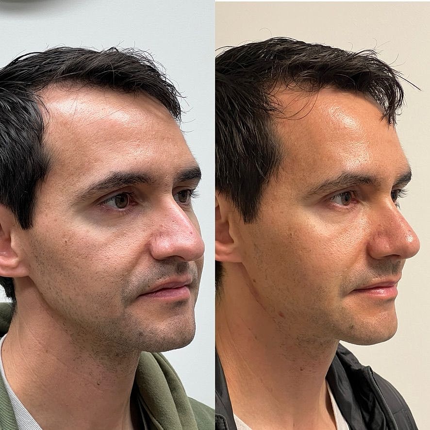 Rhinoplasty Before & After