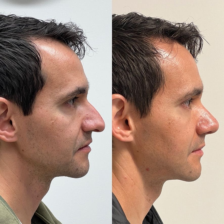 Rhinoplasty Before & After