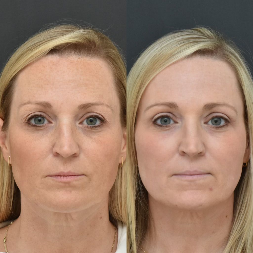 CO2 Laser Resurfacing Before & After