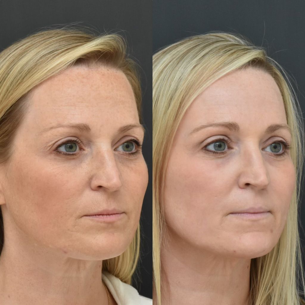 CO2 Laser Resurfacing Before & After