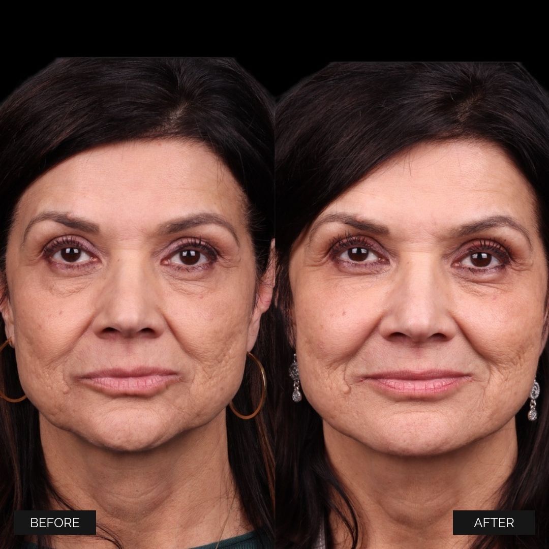 Facial Balancing Before & After