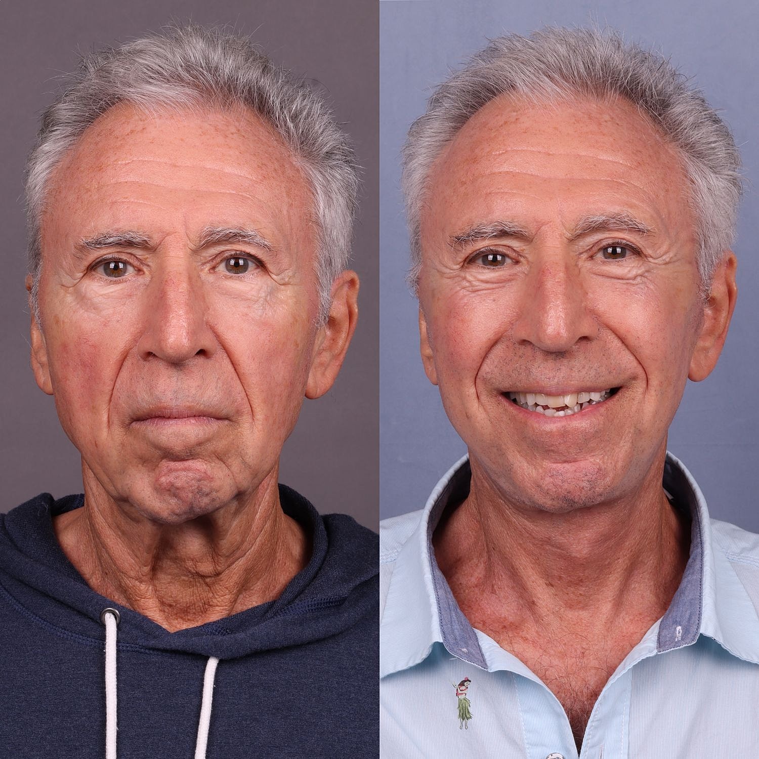 Male Facelifts Before & After