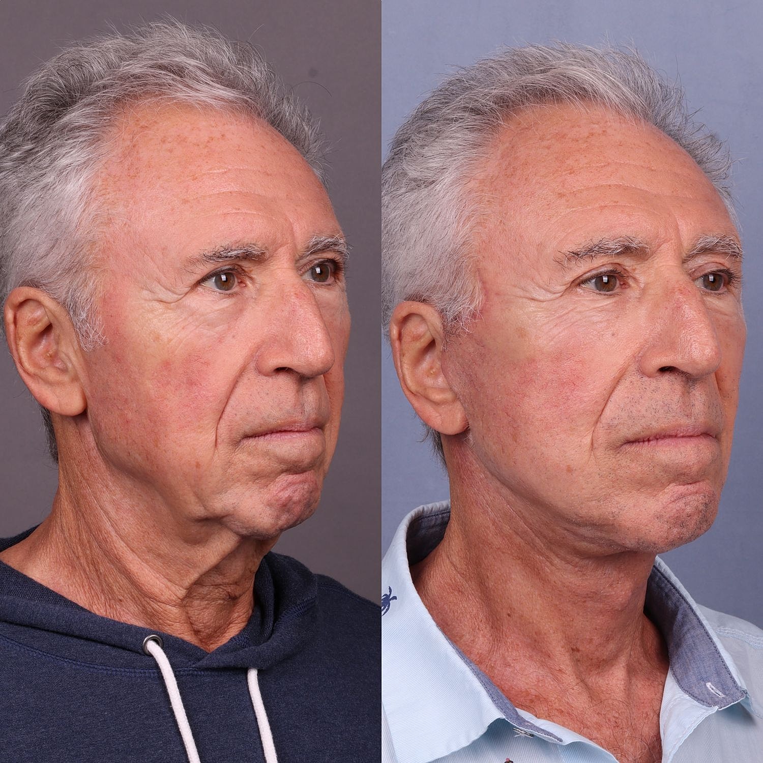 Male Facelifts Before & After