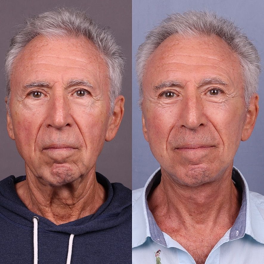 Male Facelifts Before & After