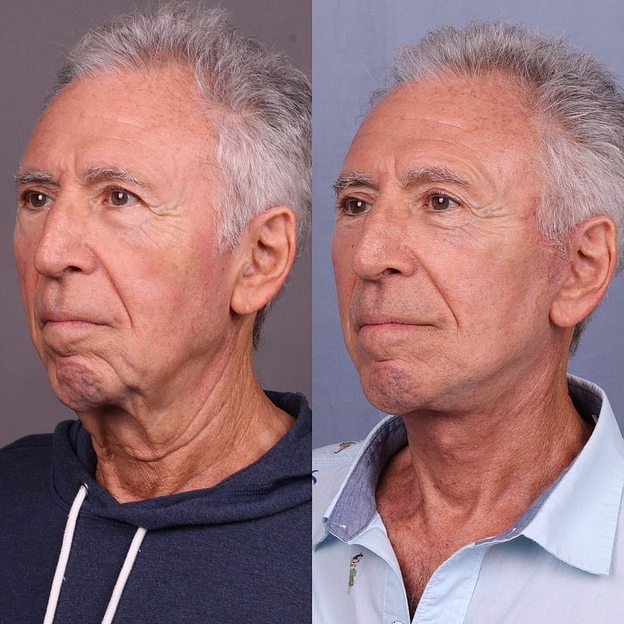 Male Facelifts Before & After