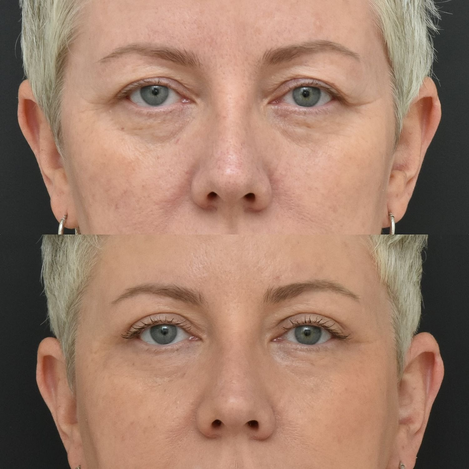 Eyelid Surgery Before & After