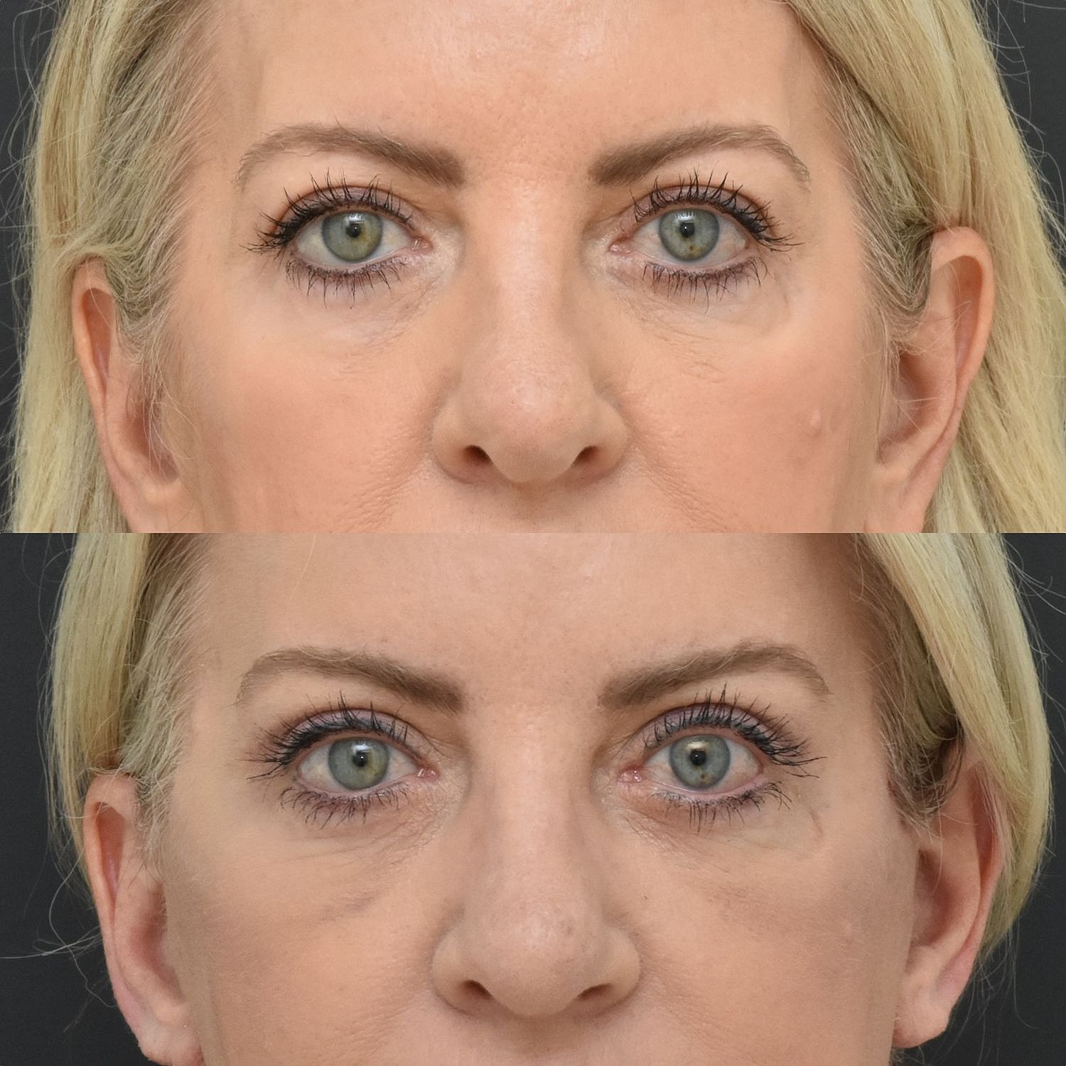 Eyelid Surgery Before & After