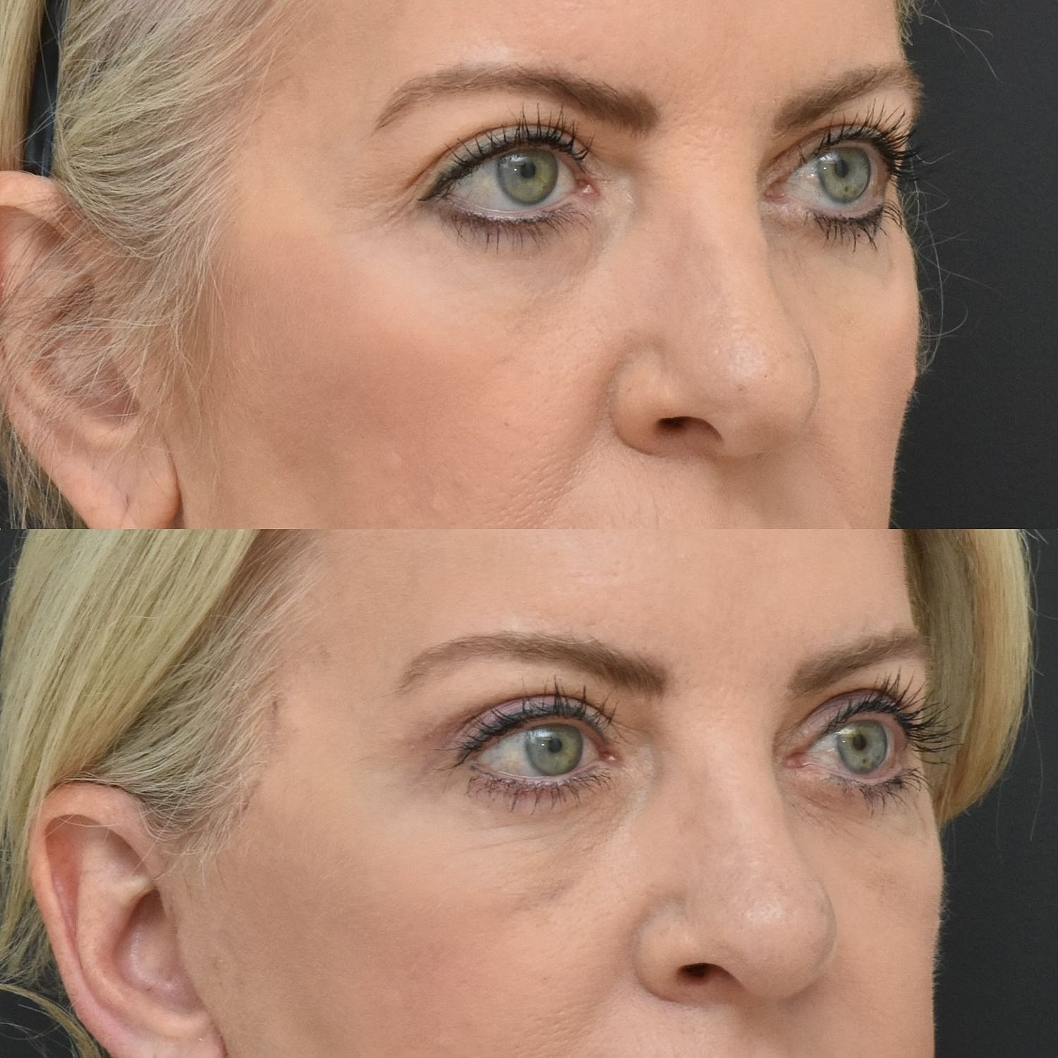 Eyelid Surgery Before & After