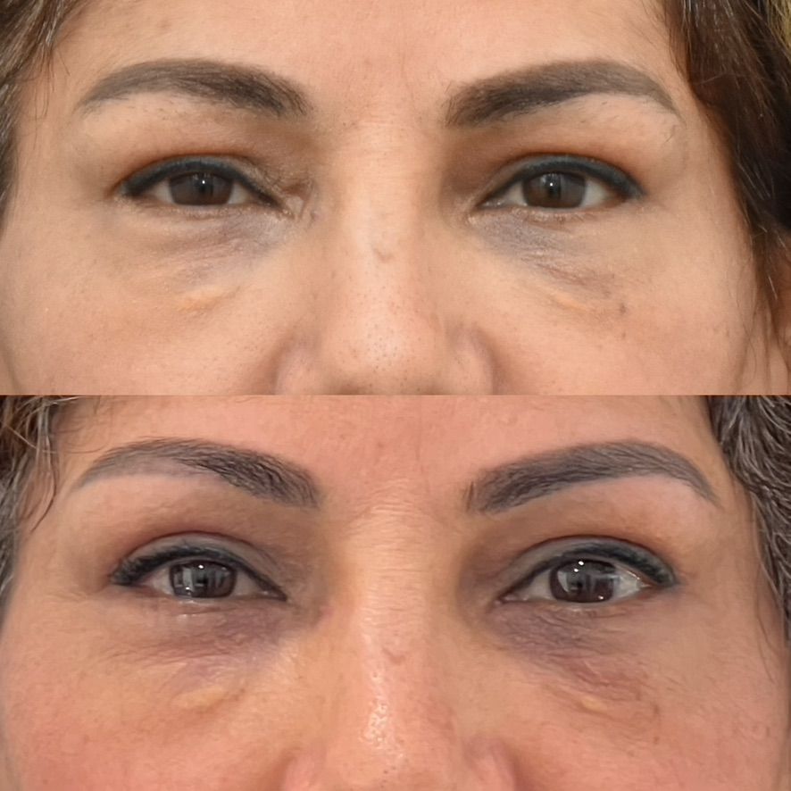 Eyelid Surgery Before & After