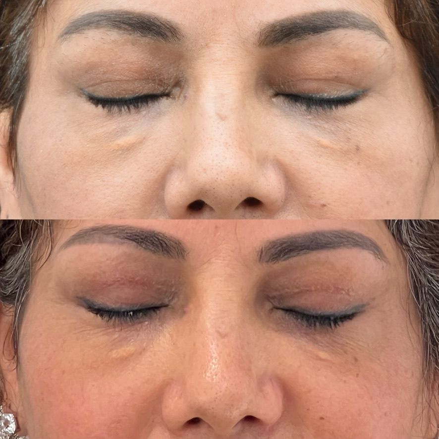Eyelid Surgery Before & After