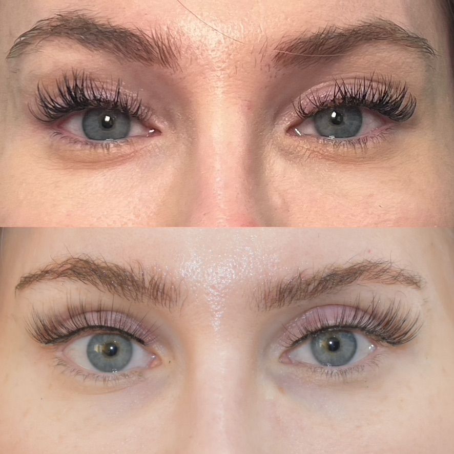 Eyelid Surgery Before & After