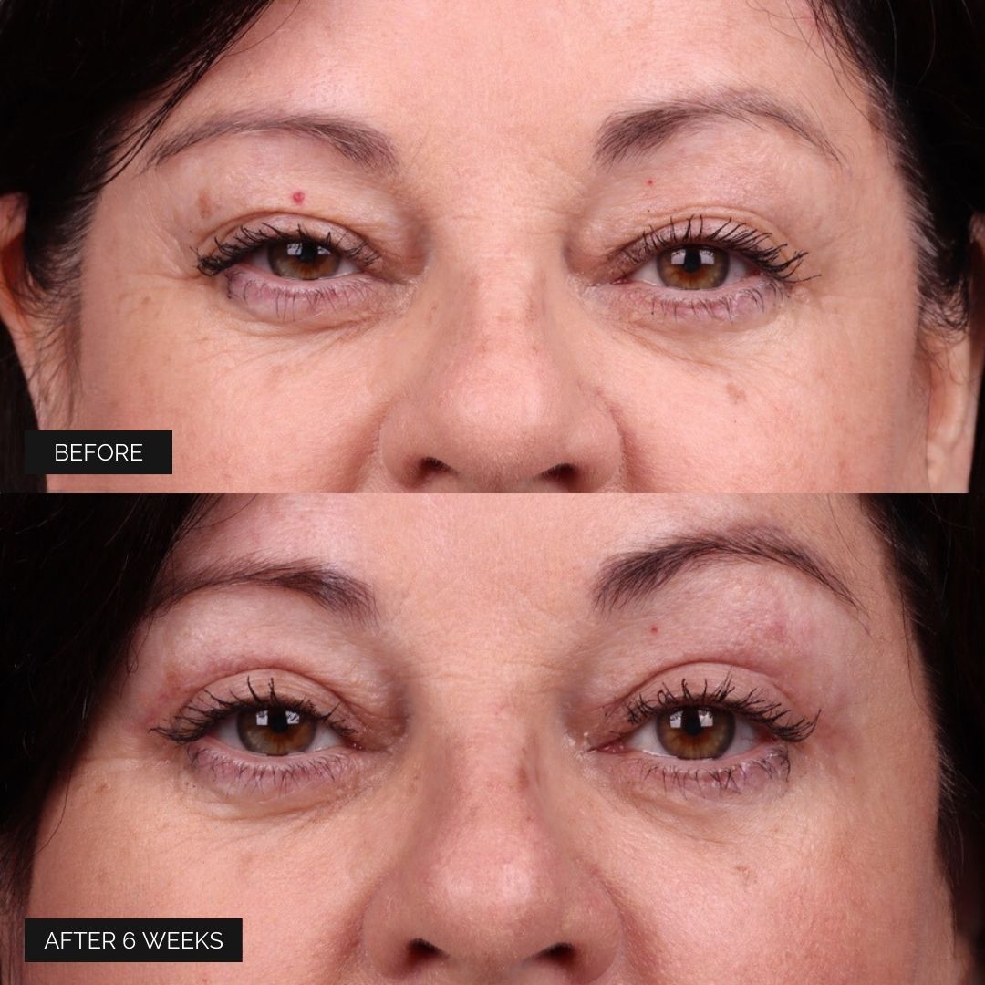 Eyelid Surgery Before & After