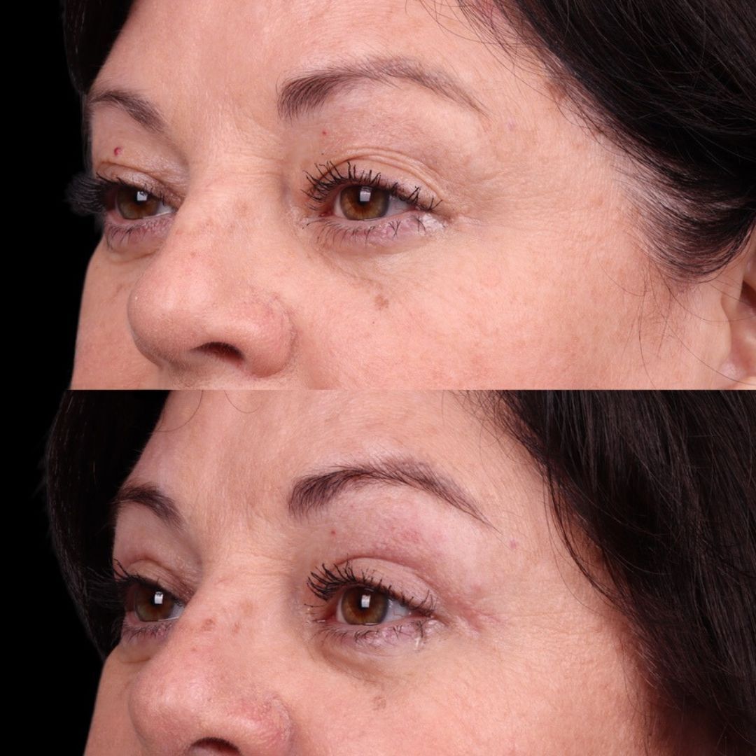 Eyelid Surgery Before & After