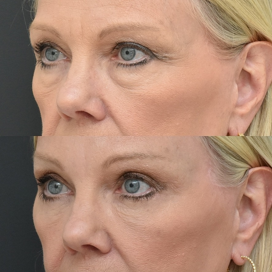 Eyelid Surgery Before & After