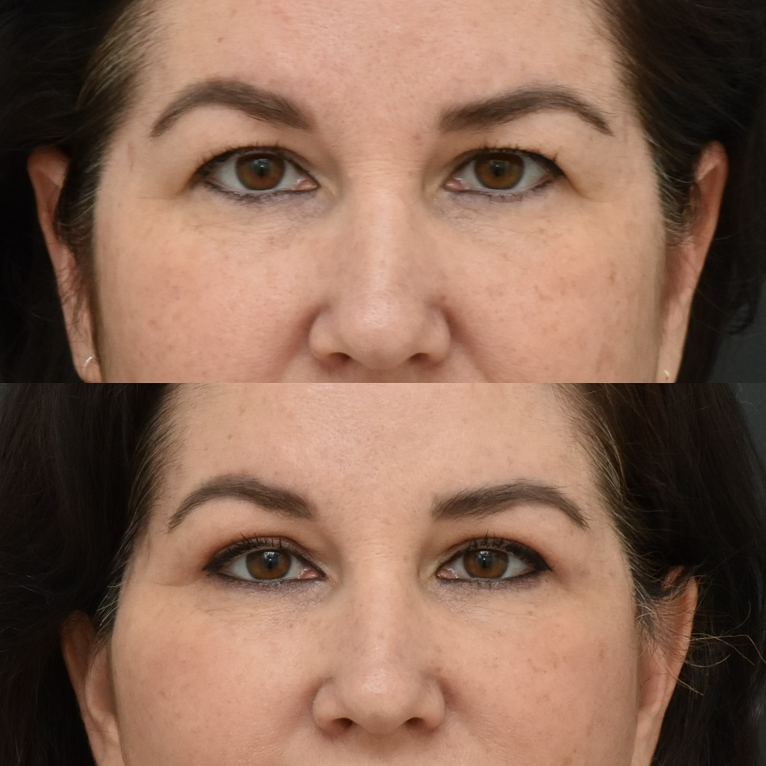 Eyelid Surgery Before & After