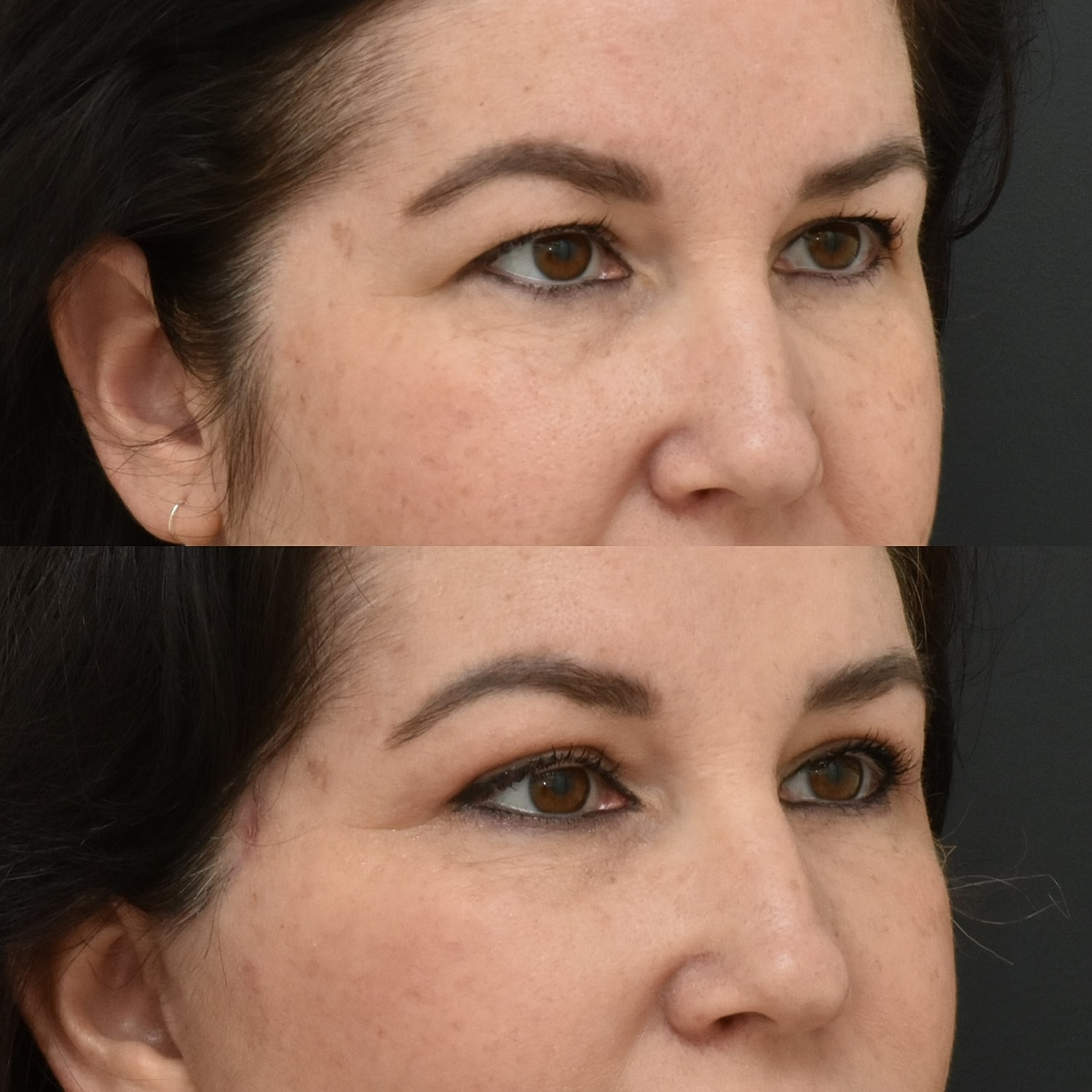 Eyelid Surgery Before & After