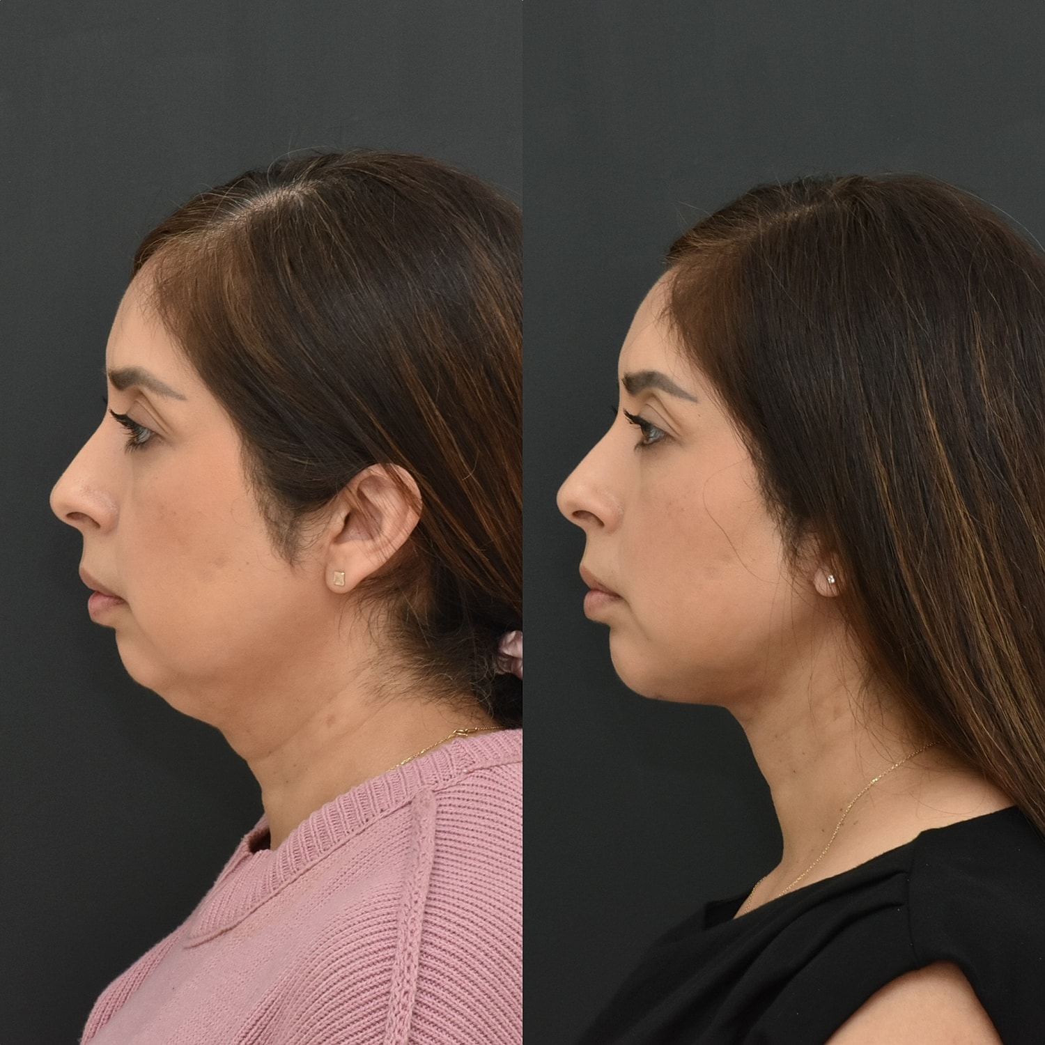 Chin Augmentation Before & After