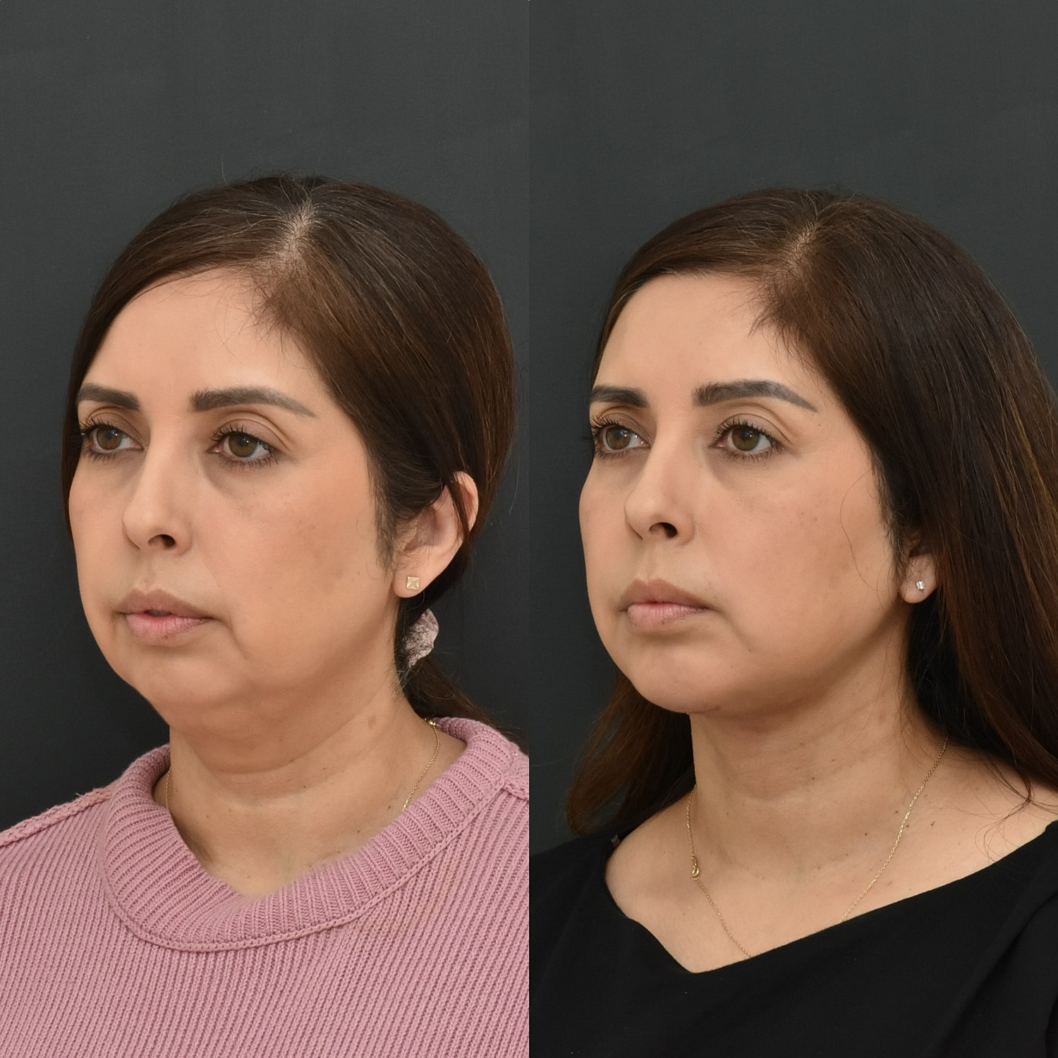 Chin Augmentation Before & After
