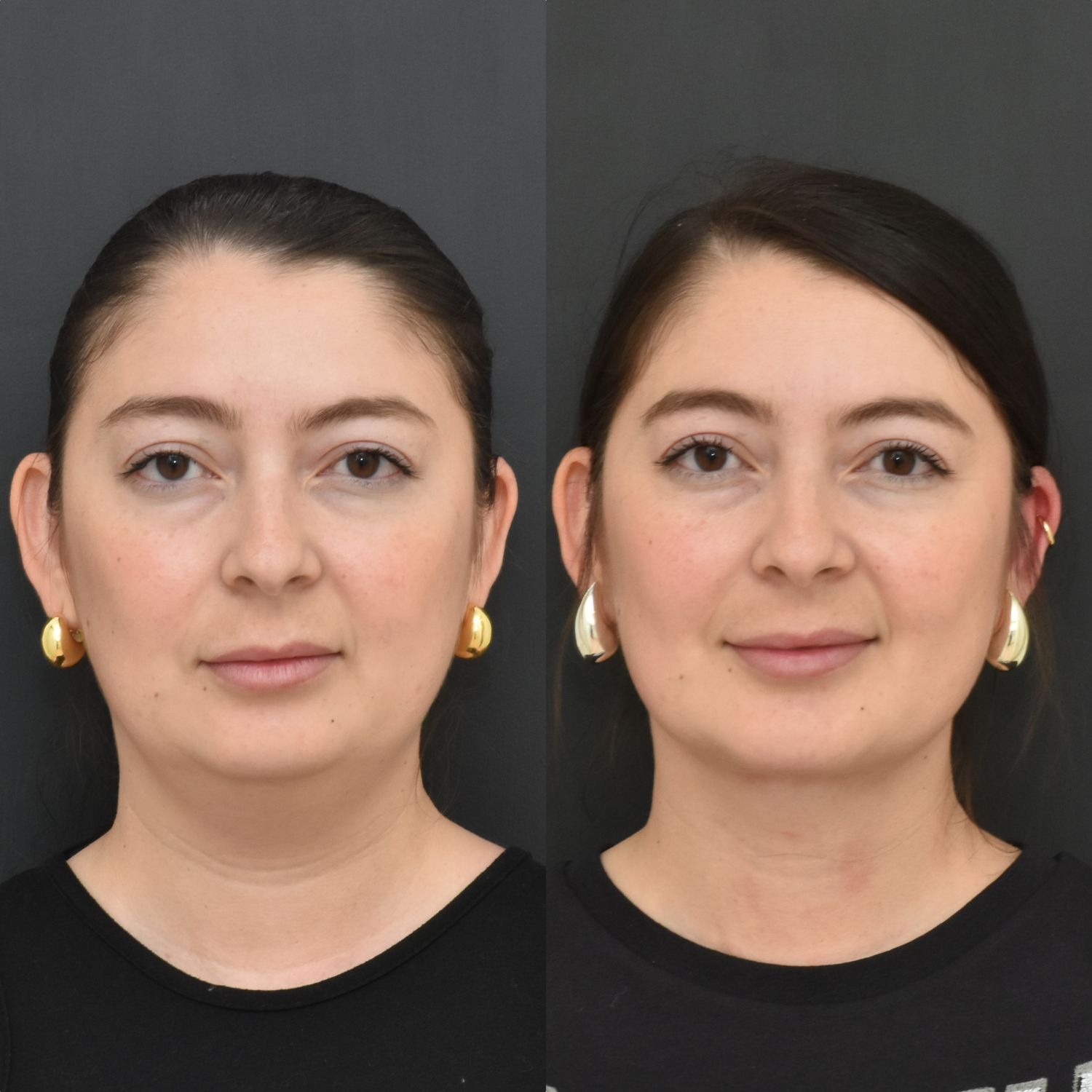 Chin Augmentation Before & After