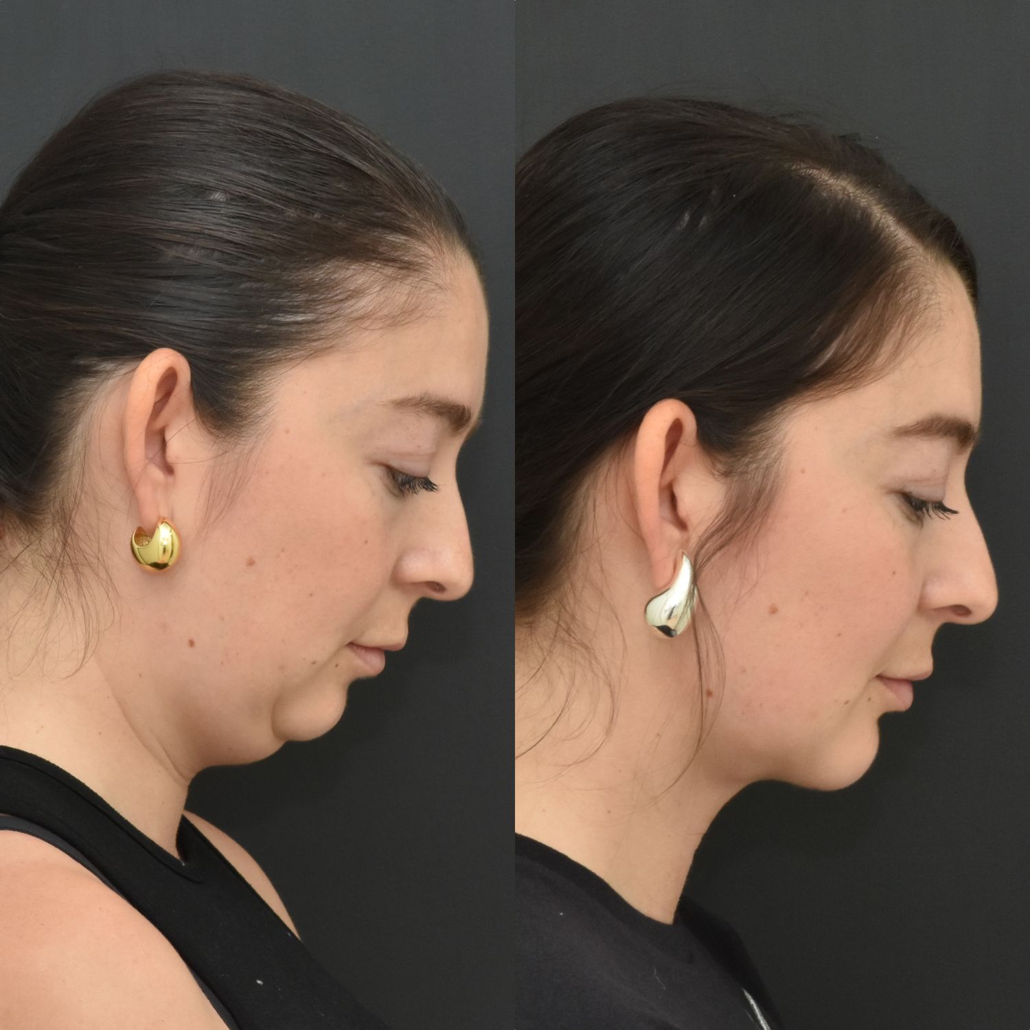 Chin Augmentation Before & After