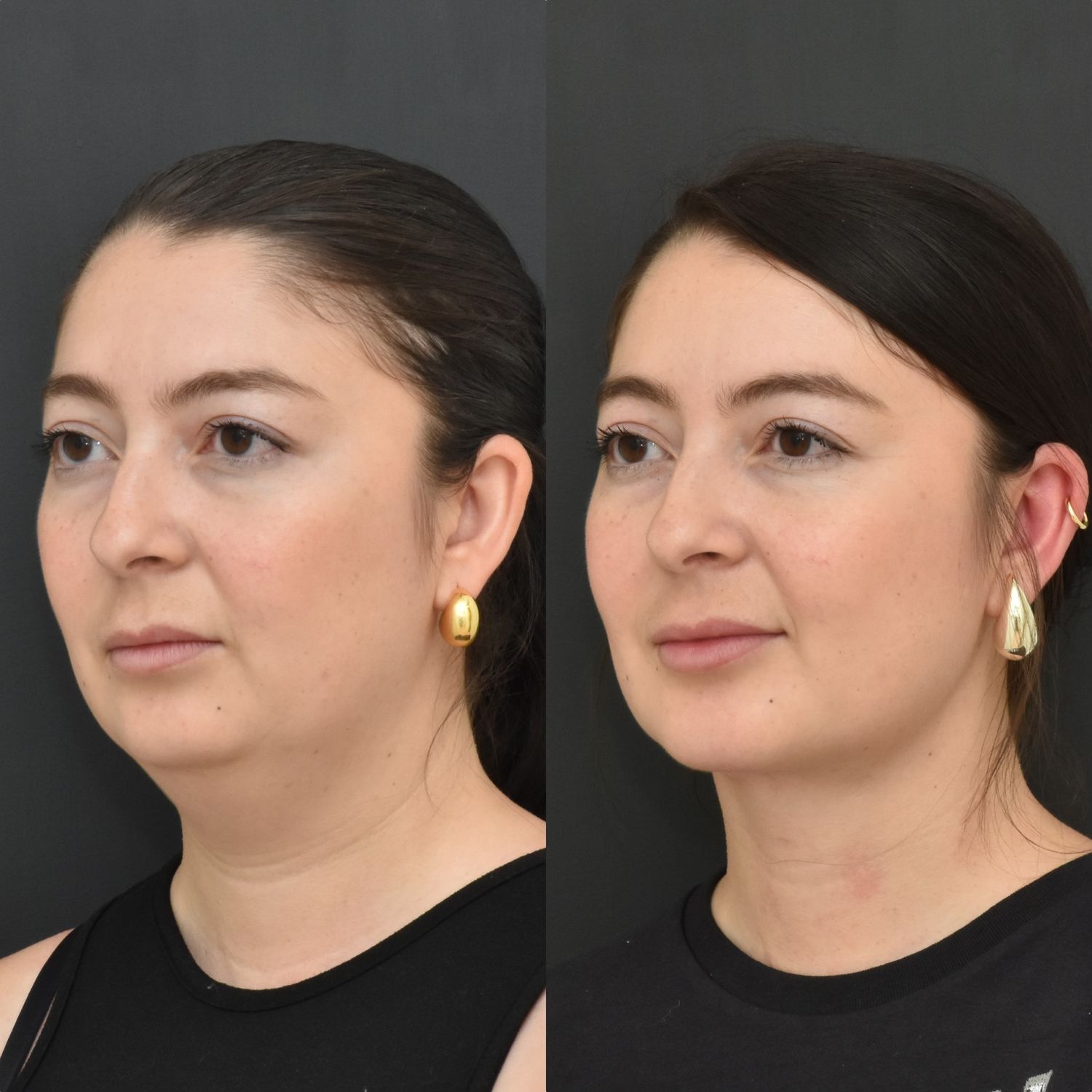 Chin Augmentation Before & After