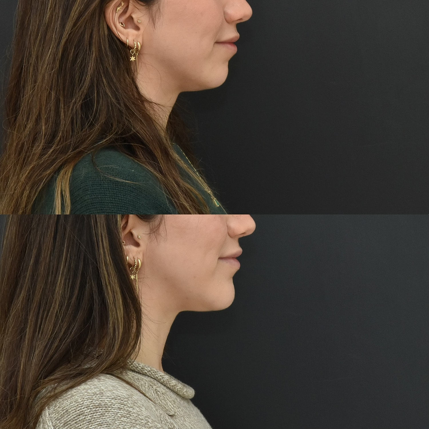 Chin Augmentation Before & After