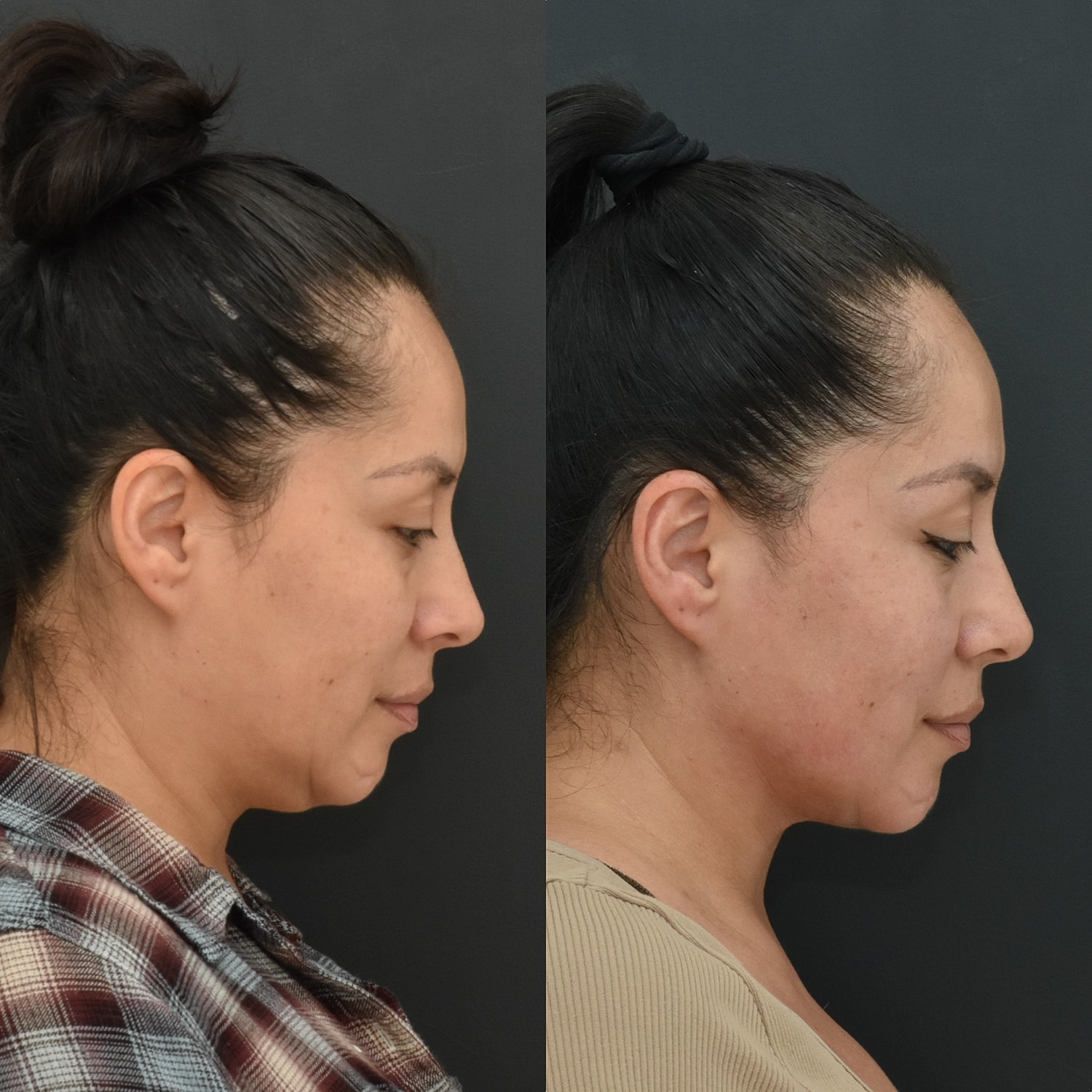 Chin Liposuction Before & After