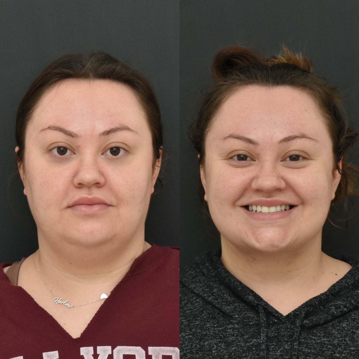 Chin Liposuction Before & After