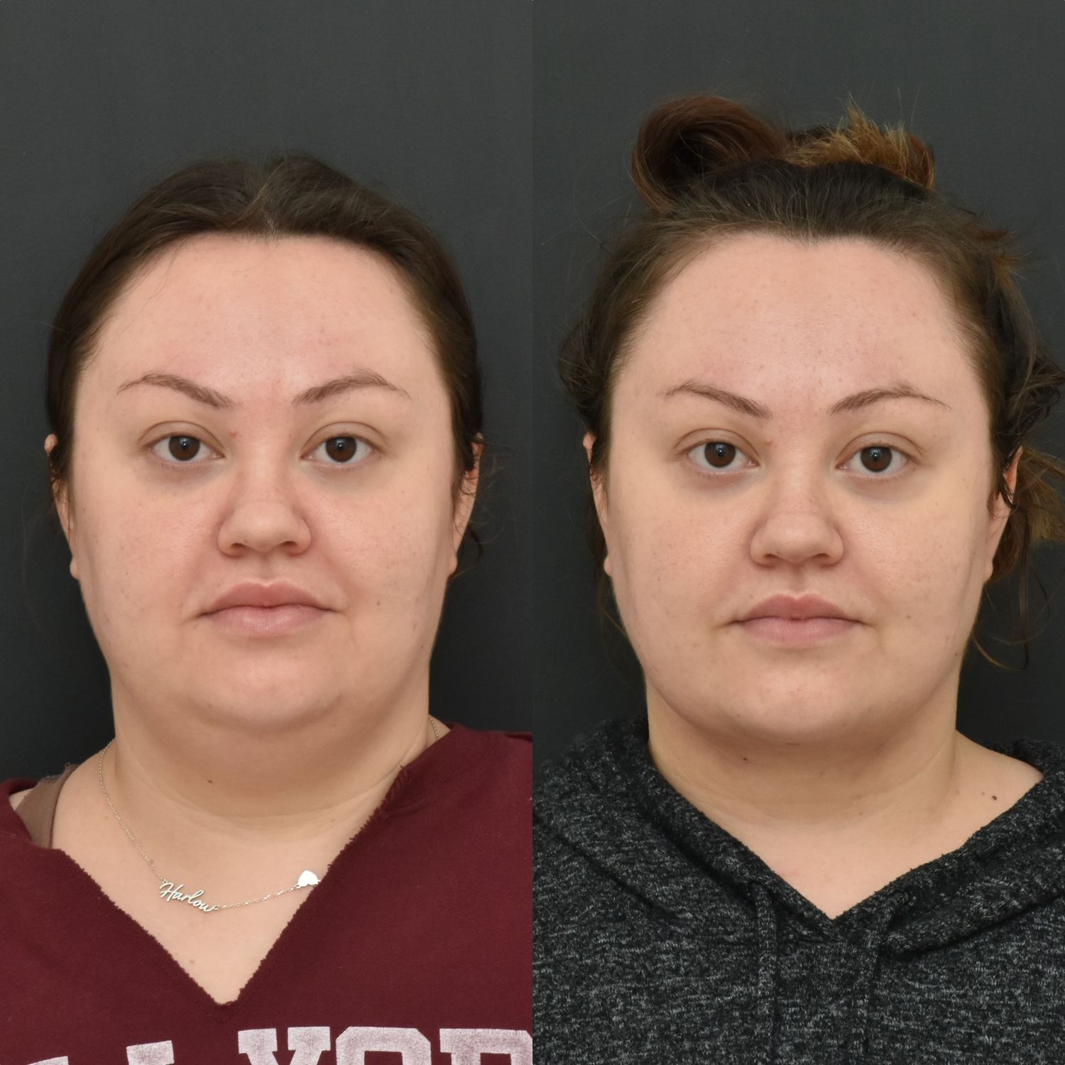 Chin Liposuction Before & After