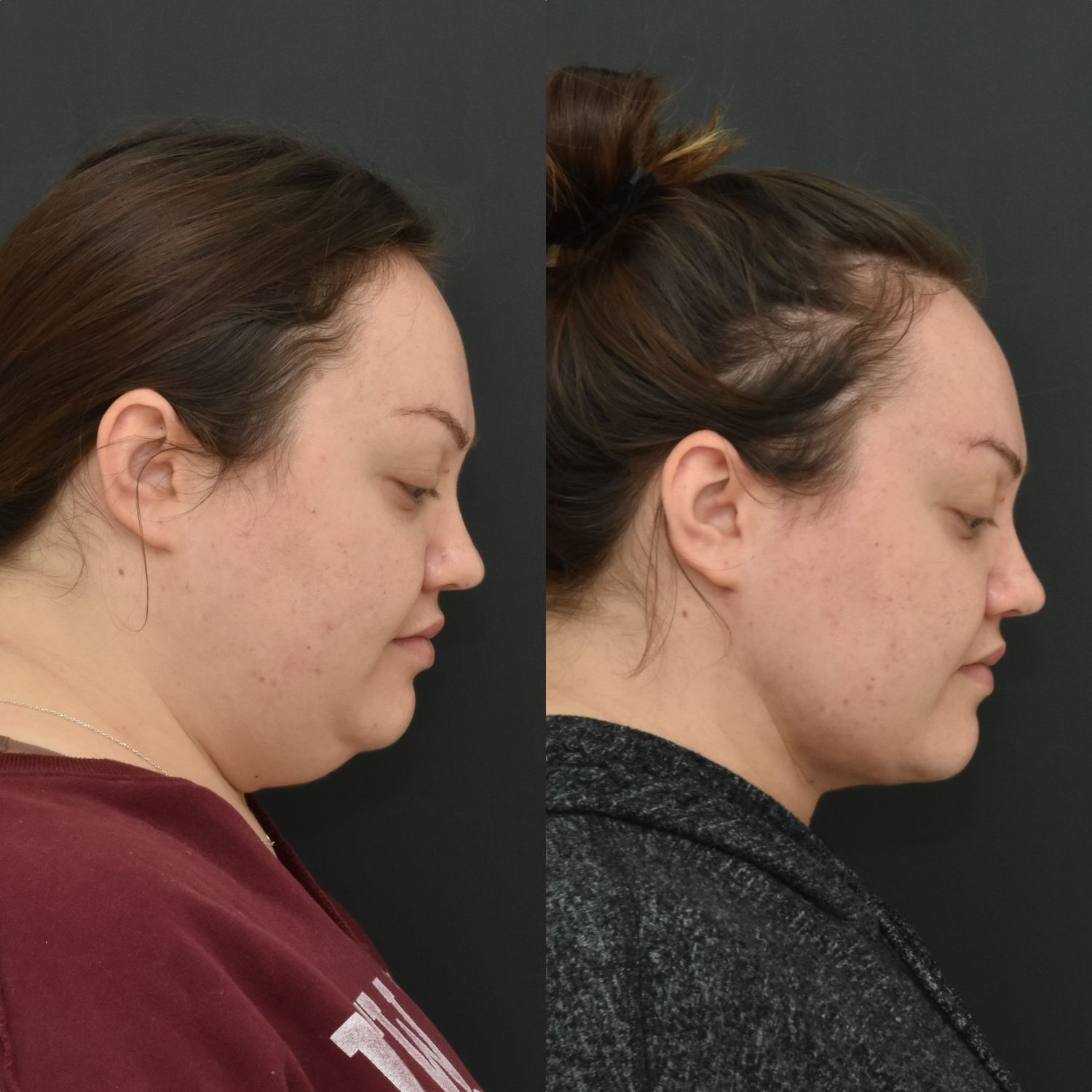 Chin Liposuction Before & After