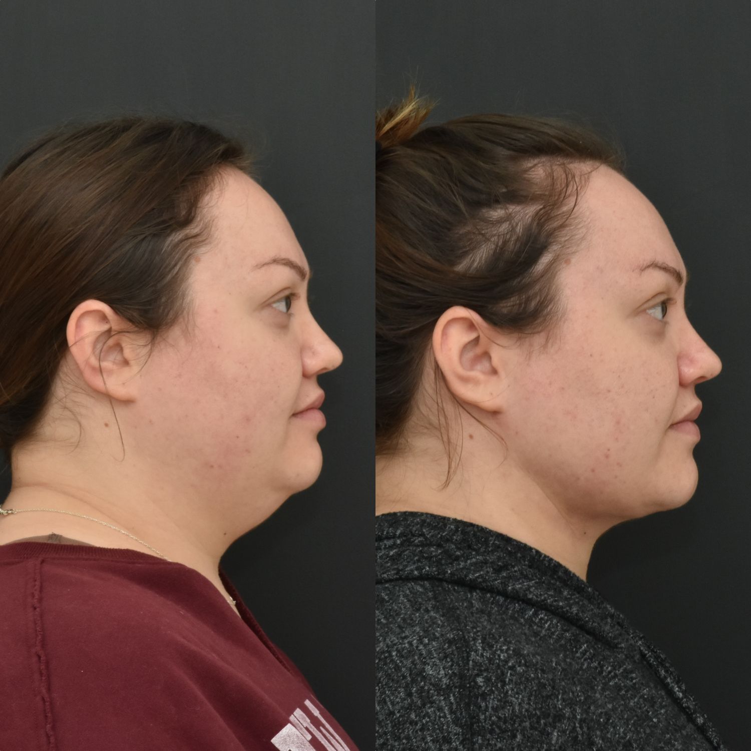Chin Liposuction Before & After