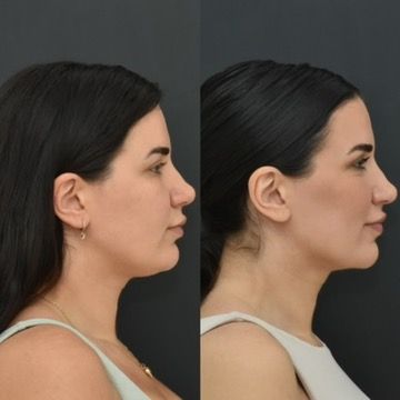 Chin Liposuction Before & After