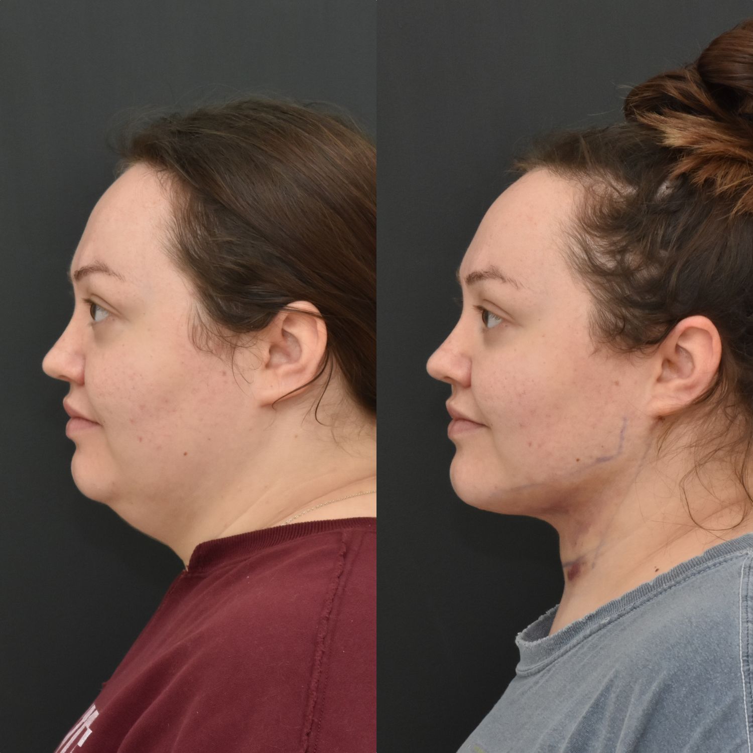 Chin Liposuction Before & After