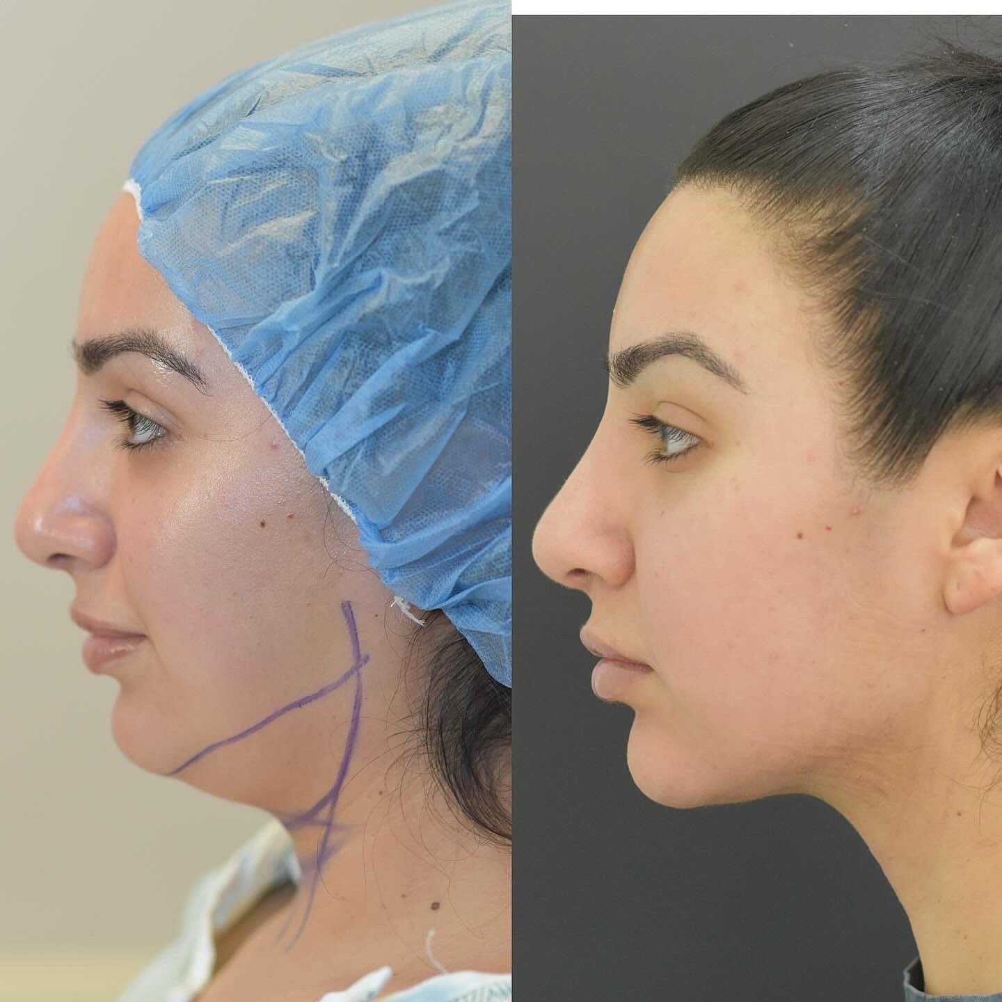 Chin Liposuction Before & After