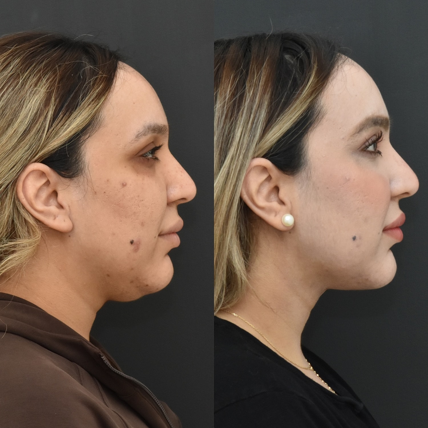 Chin Liposuction Before & After