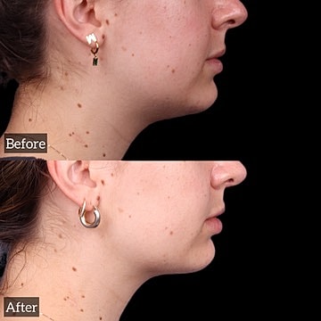 Chin Liposuction Before & After