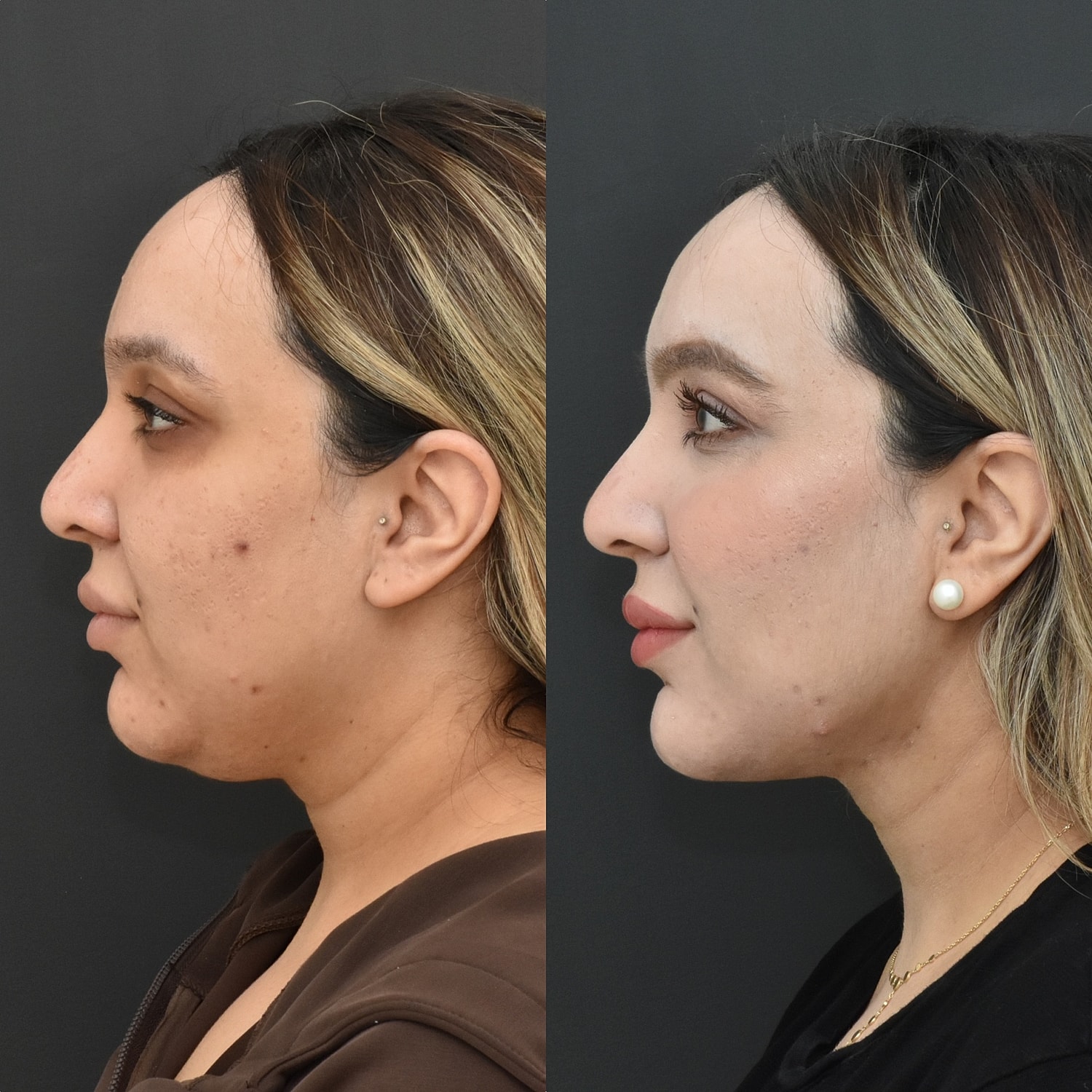 Chin Liposuction Before & After