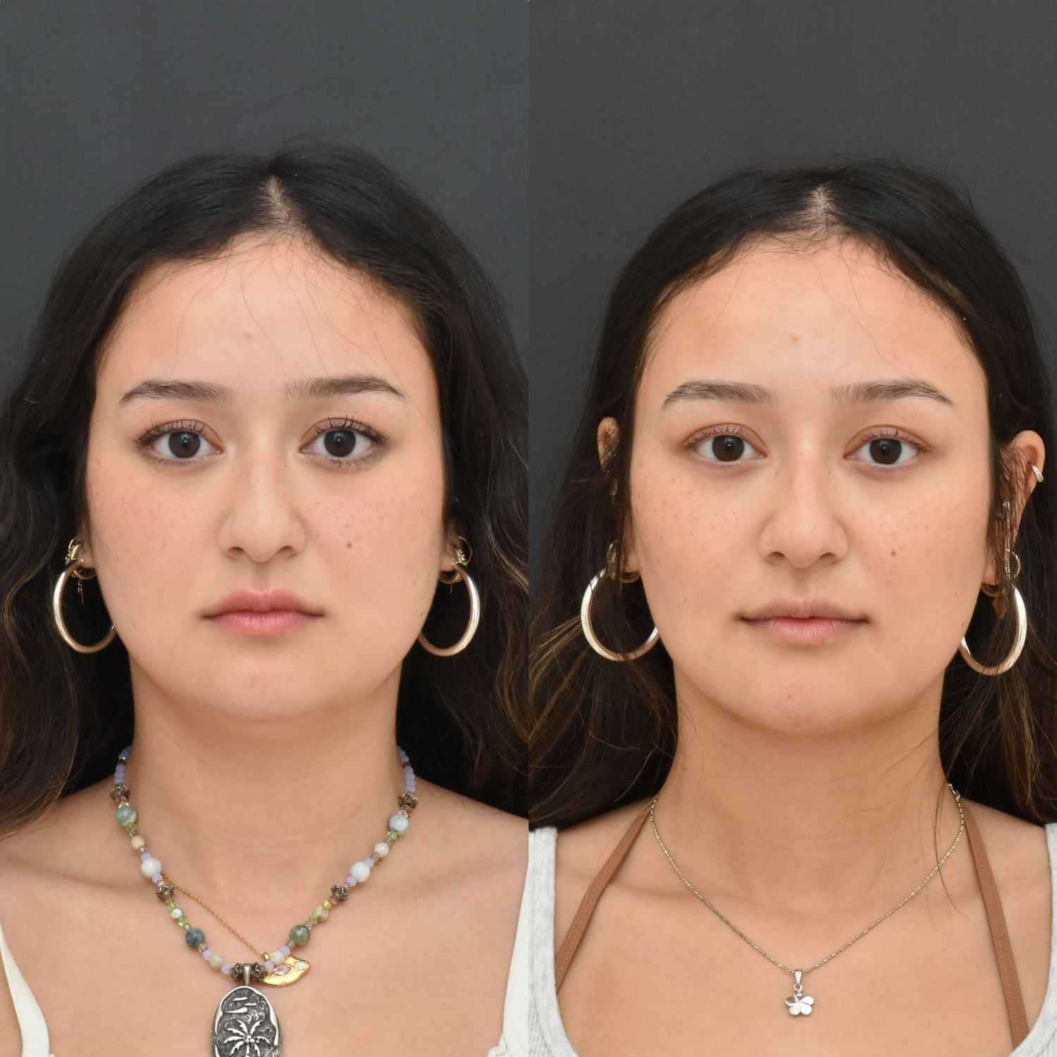 Chin Liposuction Before & After