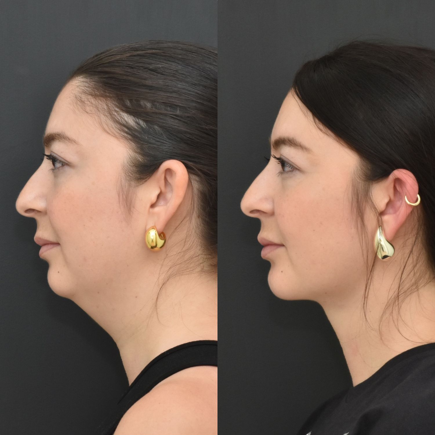 Chin Liposuction Before & After