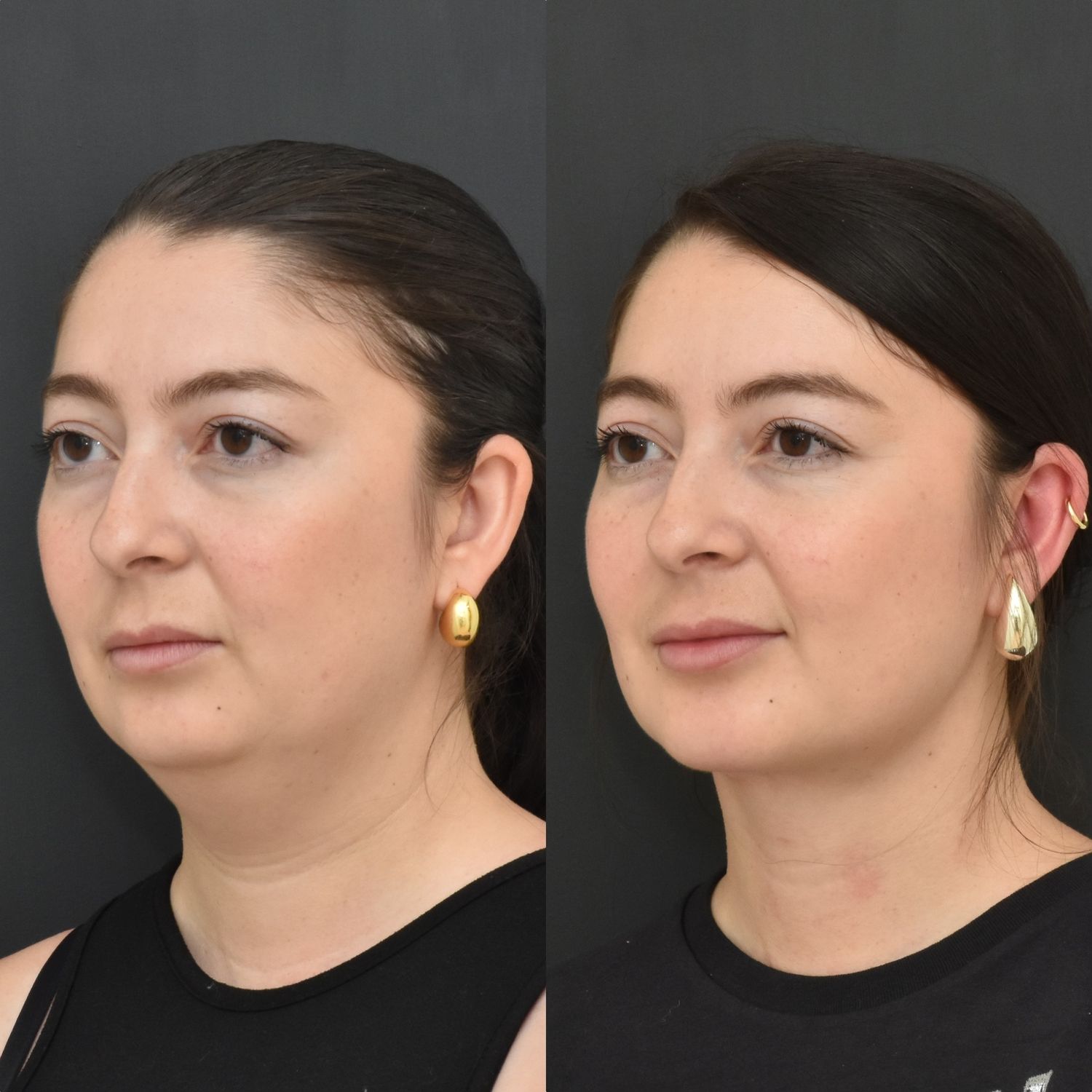 Chin Liposuction Before & After