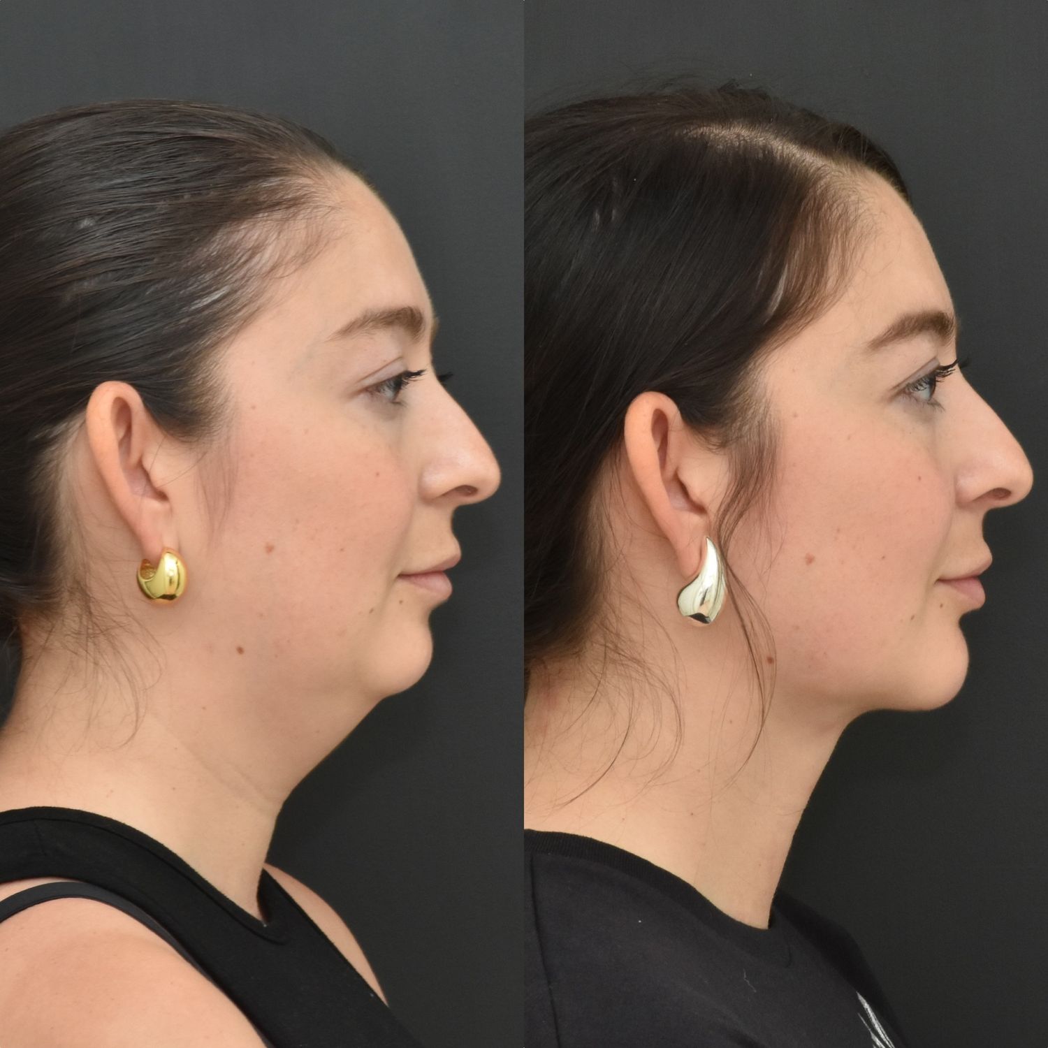 Chin Liposuction Before & After