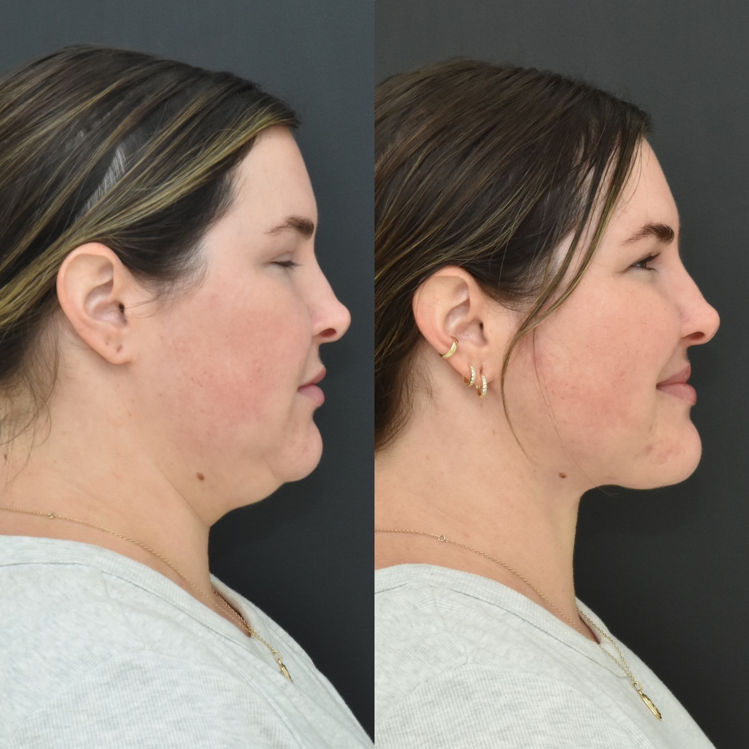 Chin Liposuction Before & After