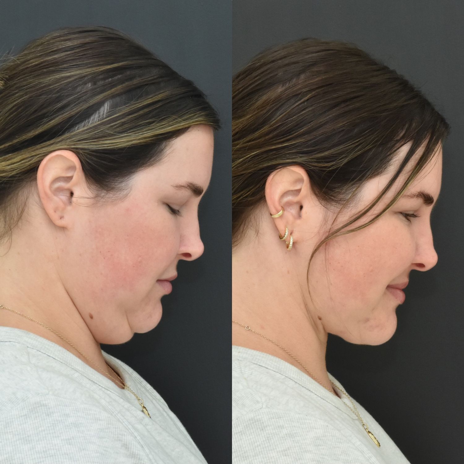 Chin Liposuction Before & After