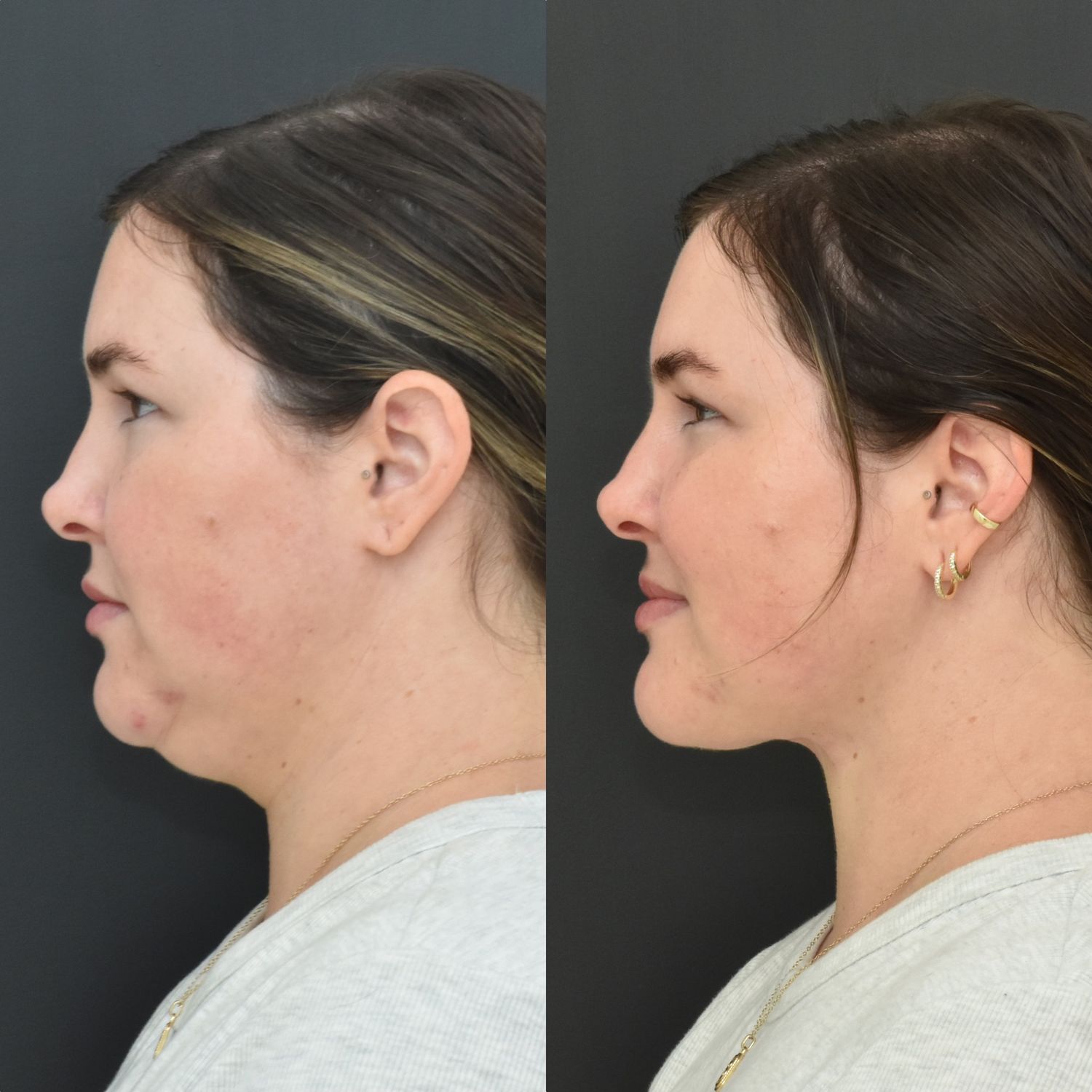 Chin Liposuction Before & After
