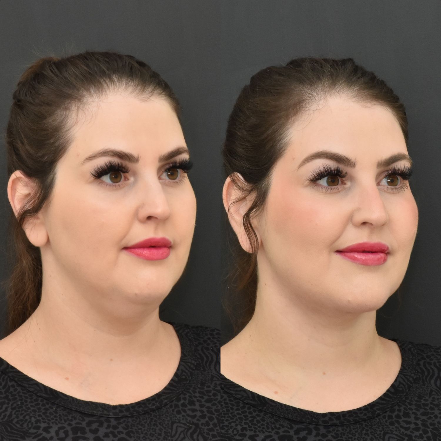 Chin Liposuction Before & After