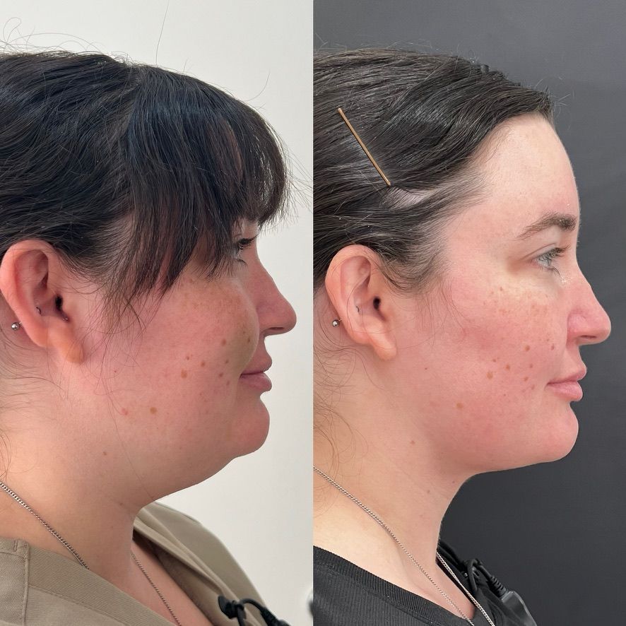 Chin Liposuction Before & After