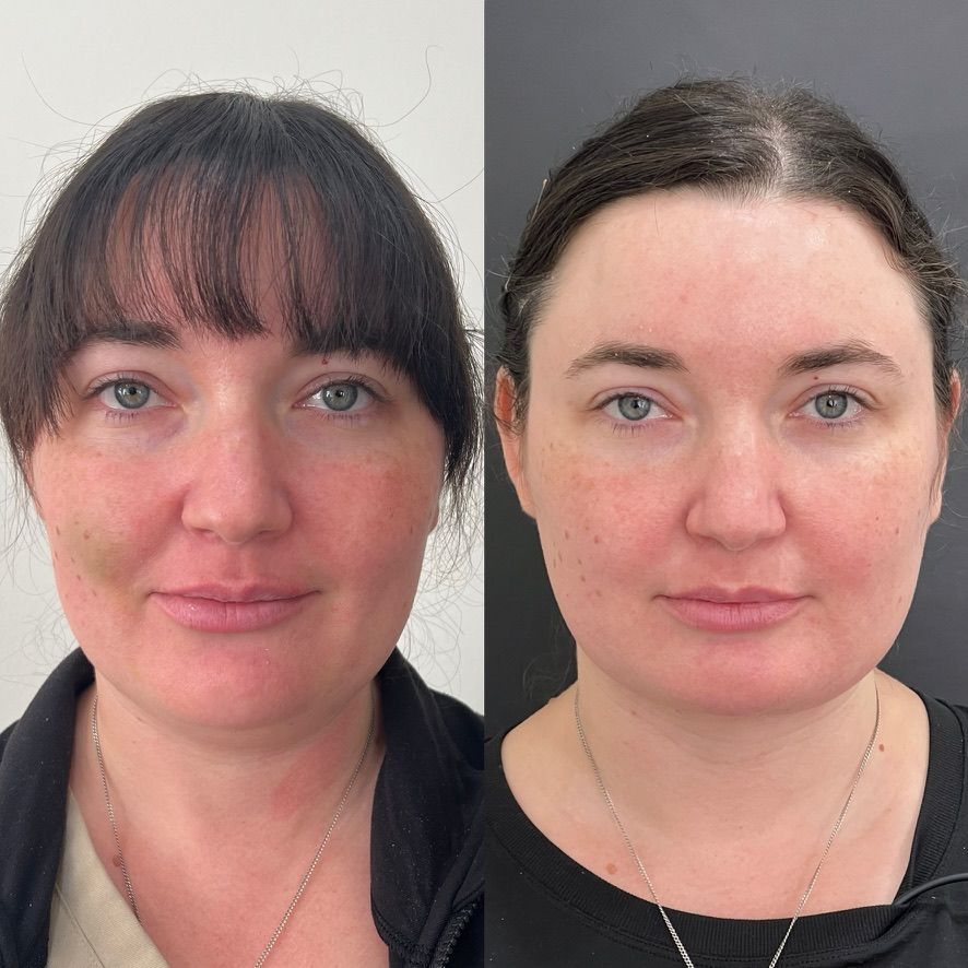 Chin Liposuction Before & After