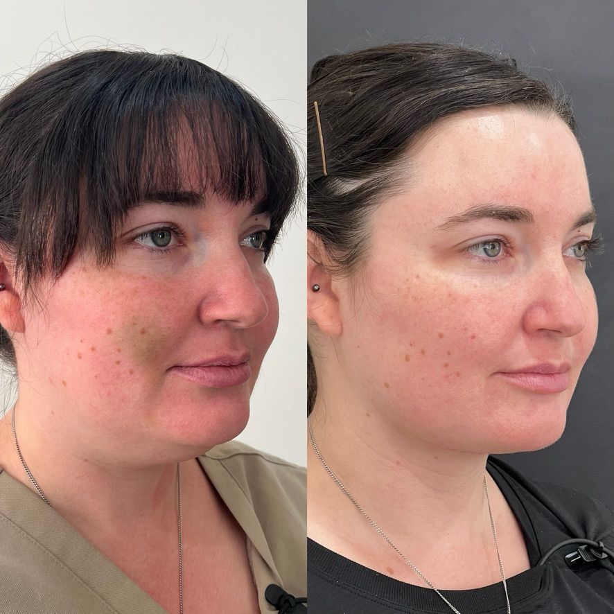 Chin Liposuction Before & After
