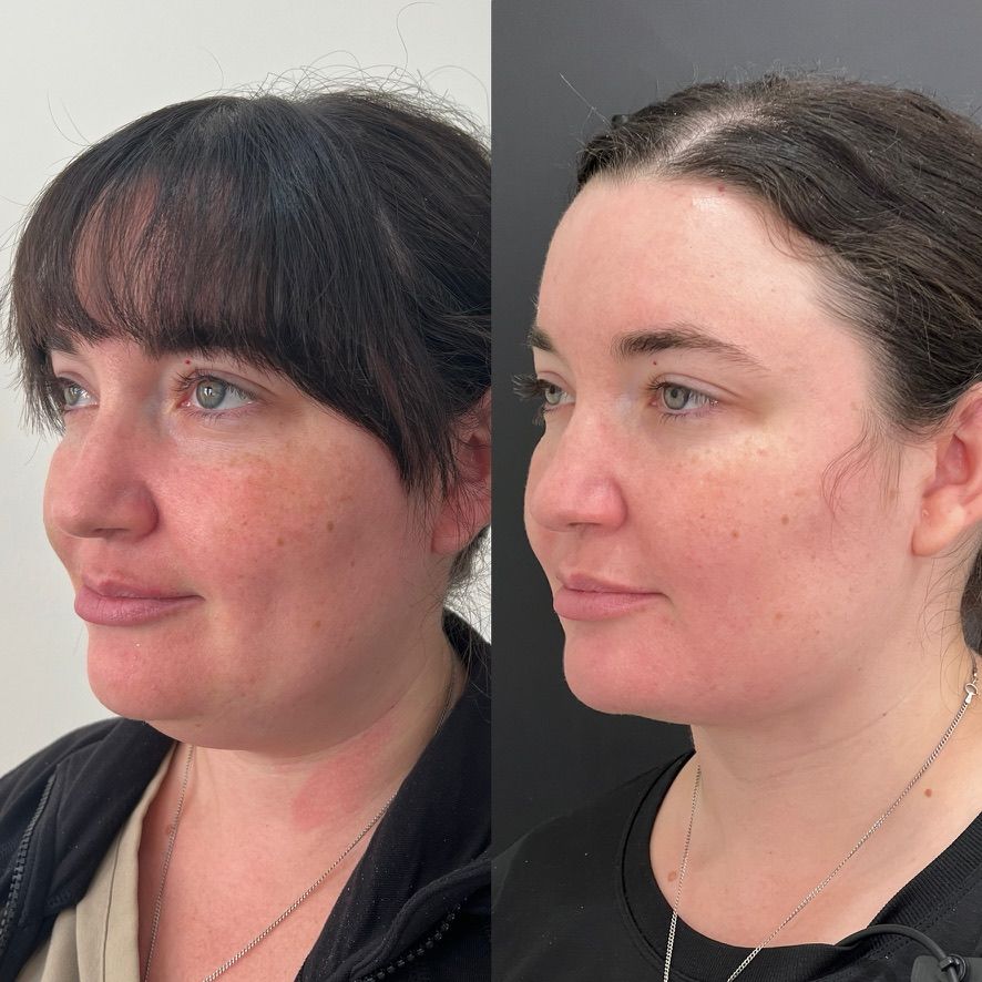 Chin Liposuction Before & After